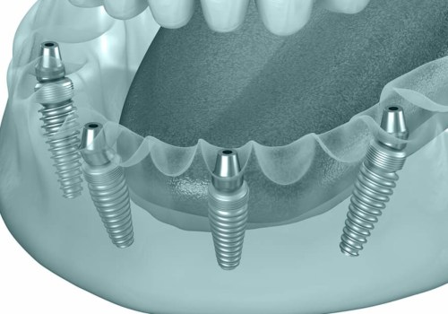 The Role Of A Children's Emergency Dentist In Basel For Young Patients Needing Teeth Implants