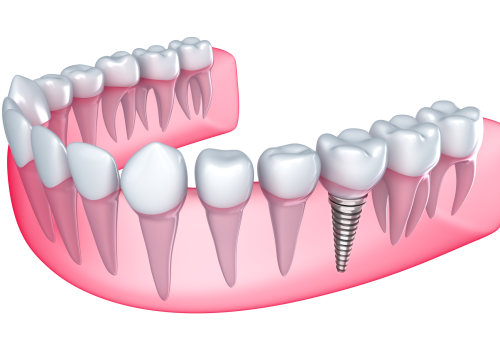 Can You Get Dental Implants After Tooth Extraction?