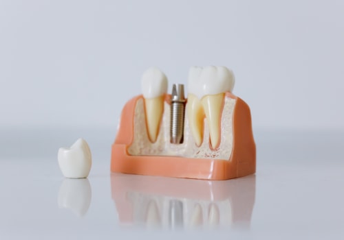 Transforming Smiles In San Antonio, TX: The Power Of Teeth Implants