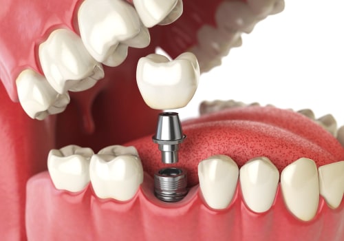 Can I Get a Dental Implant Crown Replacement?