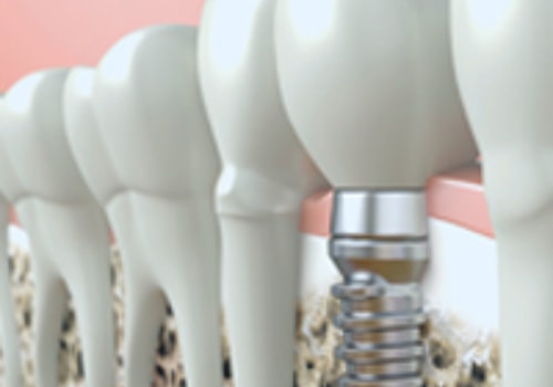 Are Dental Implants Safe for MRI?