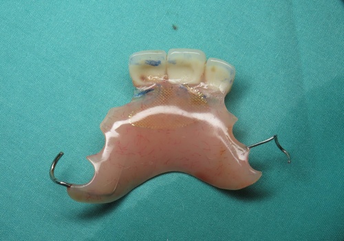 No Teeth While Waiting for Implants? Here's What You Can Do
