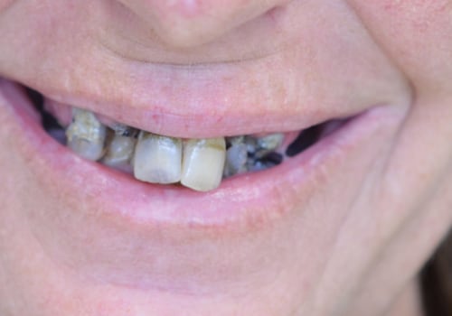 Regain Your Smile With Teeth Implants In Taylor, TX