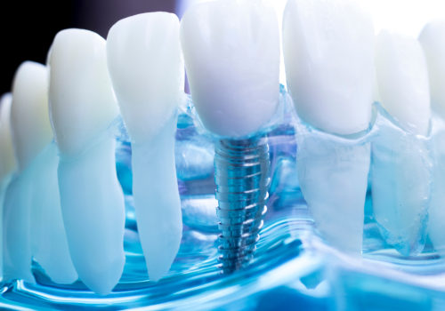 The Benefits Of Dental Implants: How Teeth Implants Can Improve Your Chewing Ability And Boost Your Confidence In Waco, TX